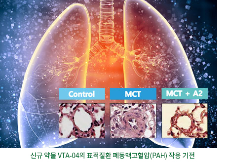 신약 약물 VTA-04의 표적질환인 폐동맥고혈압(PAH) 작용 기전